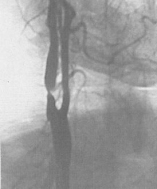 Ангиографическая диагностика стенозов сонных артерий в Красноярске