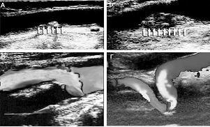 УЗИ диагностика стенозов сонных артерий в Центре Современной Кардиологии Красноярск