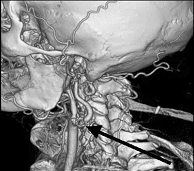 МРТ диагностика стенозов сонных артерий в Красноярске