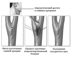 Хирургическое лечение стенозов сонных артерий в Красноярске